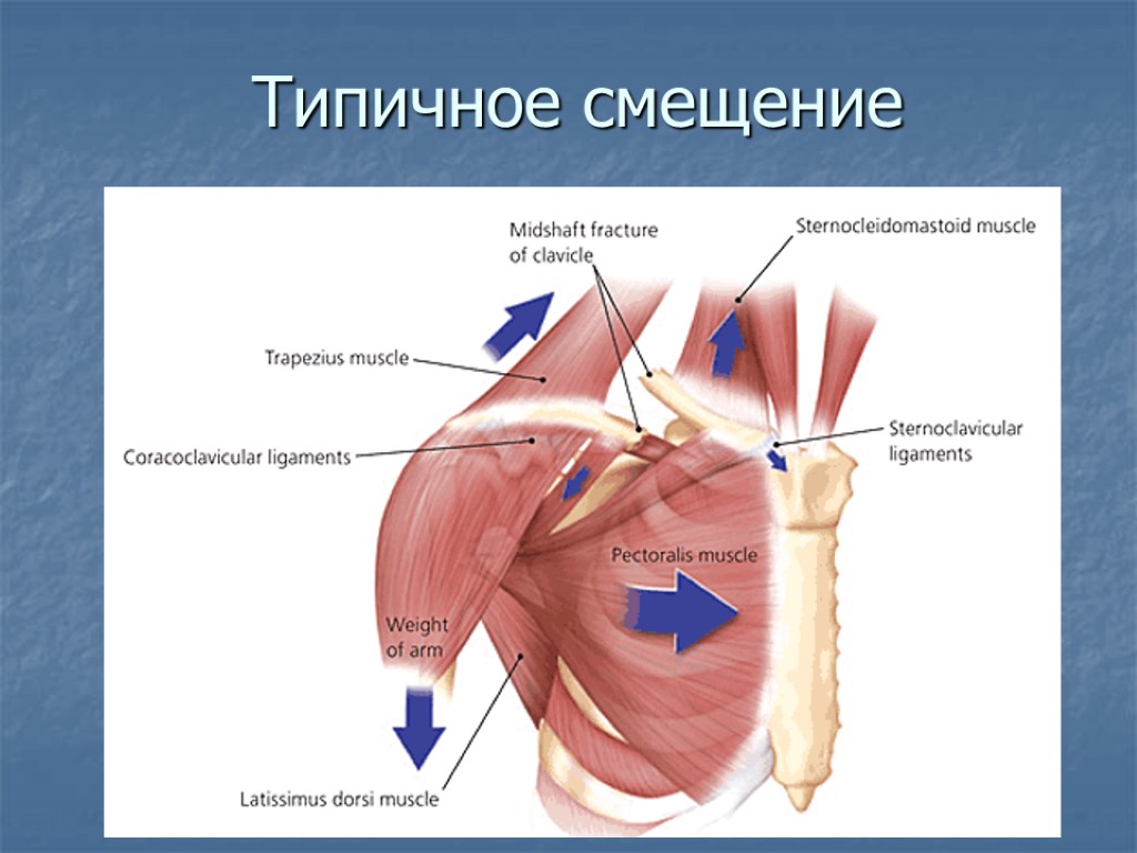 Типичное смещение